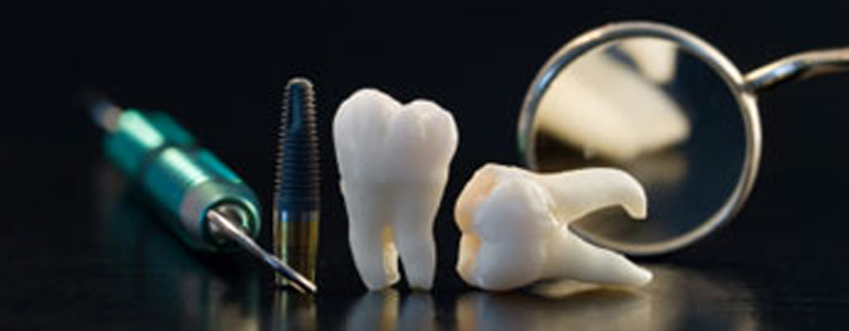 dentista parma implantologia a carico immediato